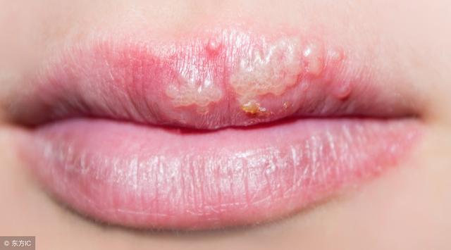 口腔疱疹病毒怎样引起的,备孕期间口腔有疱疹吃什么药