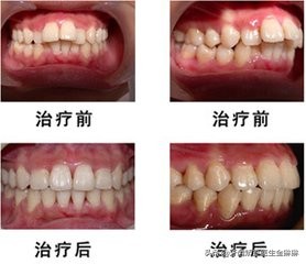 牙齿正畸前后变化大吗？带你看牙齿矫正变化图