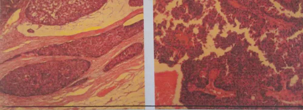 多学科联合治愈高龄患者,多学科治疗晚期肿瘤