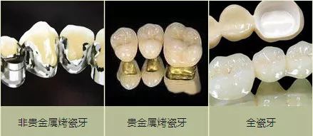 烤瓷牙做桩要另外收费吗,沈阳烤瓷牙哪家便宜又好