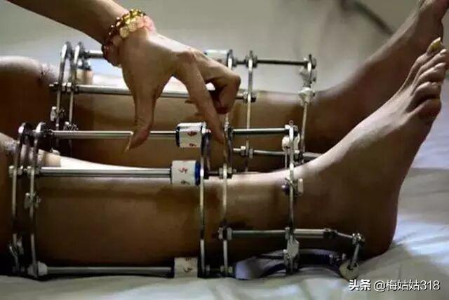 断骨增高手术的李亚诺现状,李亚诺谈断骨增高