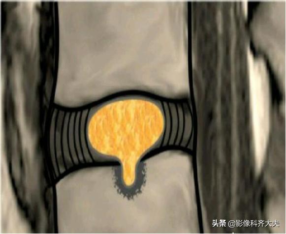 腰椎间盘突出的影像学诊断及治疗,腰椎间盘突出影像学课件