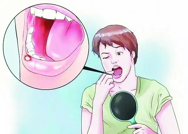经常口腔溃疡和肿瘤有关系吗,肿瘤病人口腔溃疡的护理
