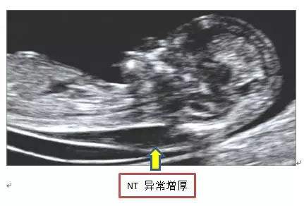 nt增厚胎儿一定会有问题吗,nt增厚的宝宝会不会很笨