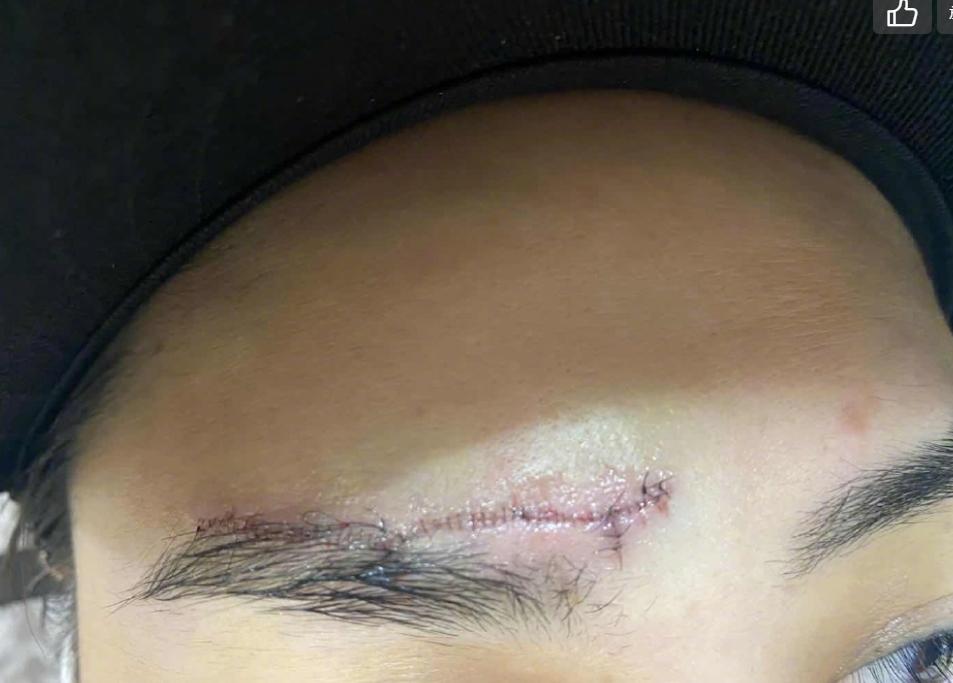 医美专家爆阿娇6㎝伤口肯定留疤痕，激光也难以恢复平滑肌肤