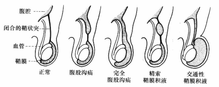 睾丸鞘膜积液和疝气能长好吗,鞘膜积液和疝气能一起做手术吗