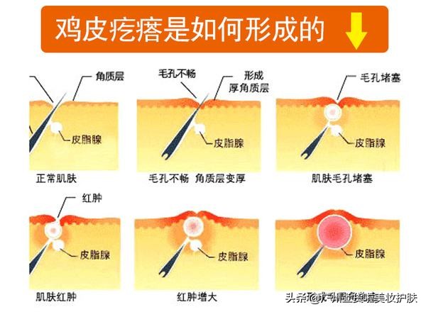 火辣夏季，想做个热辣女神，然而鸡皮肤却毁了你的热夏梦？