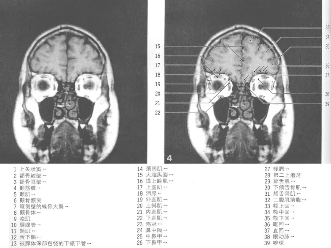 颅脑冠状状切面解剖图,颅脑mr解剖结构图