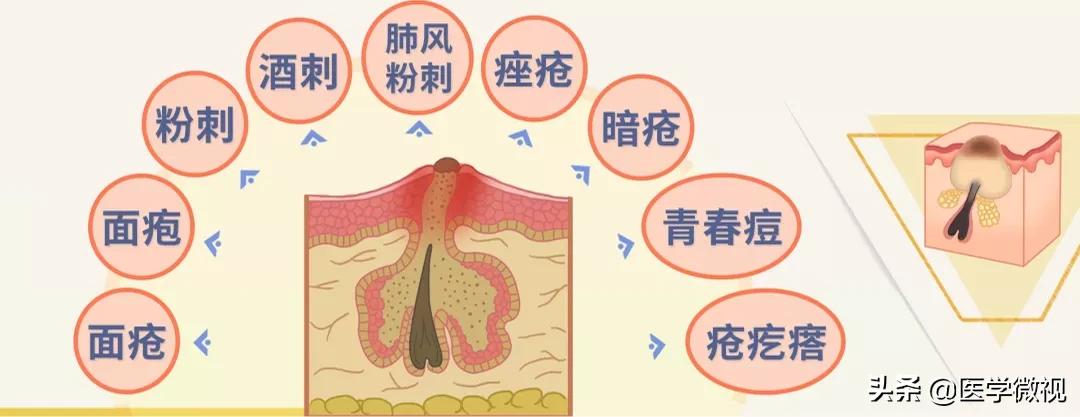 满脸痘痘怎么治不花钱,满脸痘痘中药调理效果如何