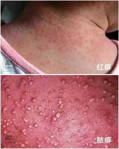 幼儿麻疹出疹子后禁忌,小儿疹子和麻疹的区别