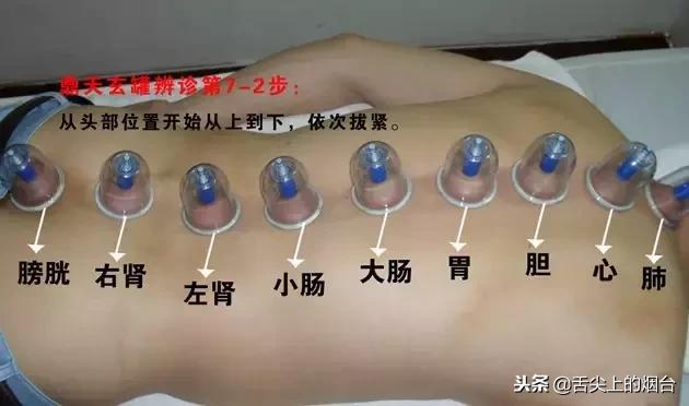 你知道拔罐后，会怎样么？真的太吓人了，看看吧！