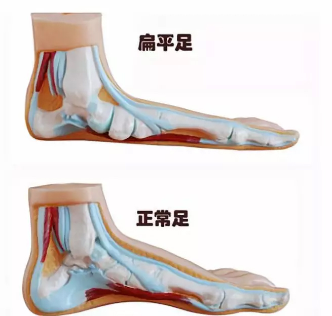 扁平足好还是不是扁平足好,什么是扁平足好治吗