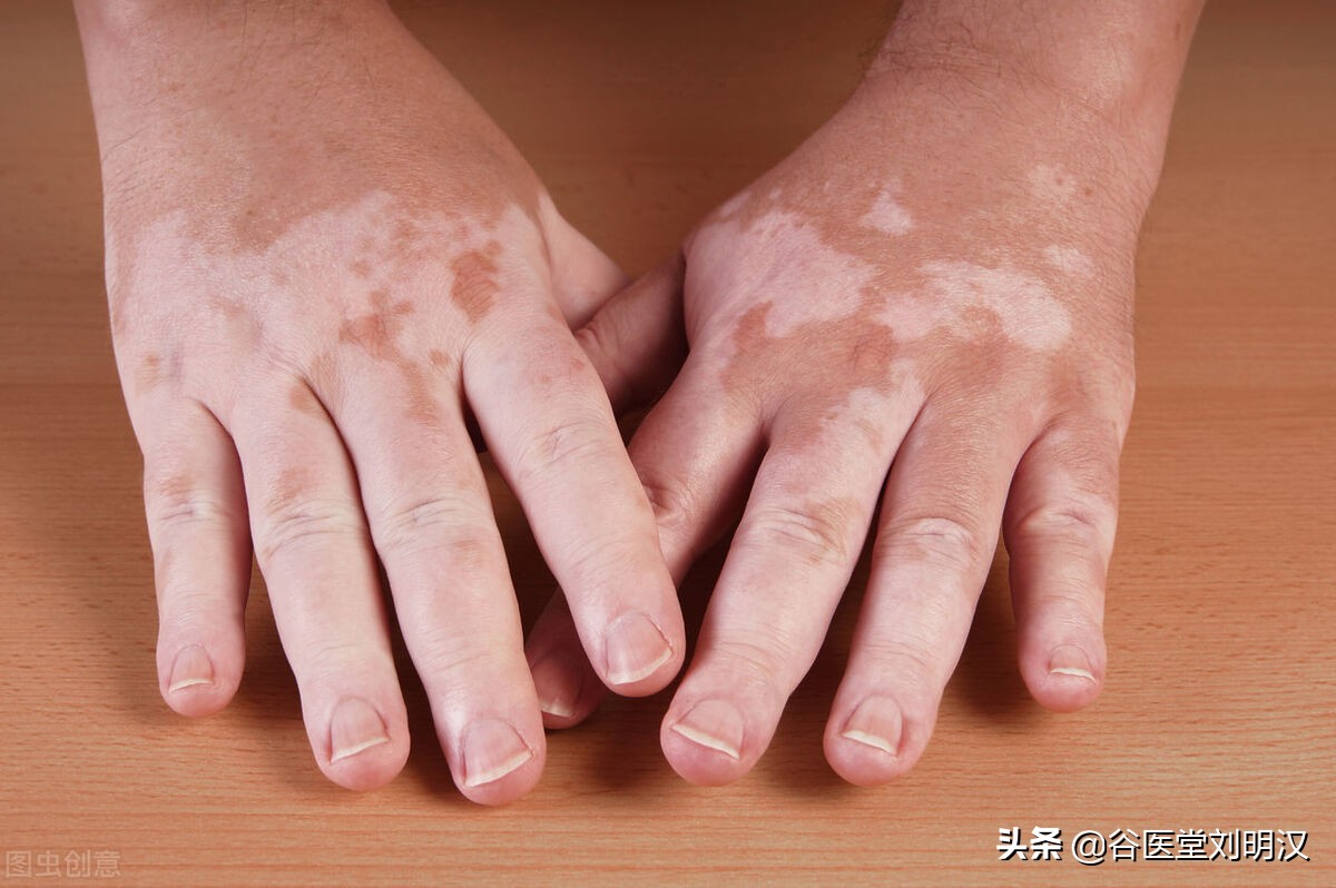 哪些方法能辅助治疗白癜风,白癜风患者如何正确应对