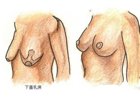 乳房下垂矫正方法有哪些,解决乳房下垂有什么方法