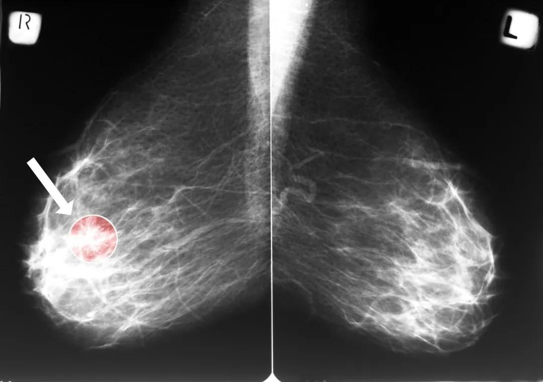 乳房内包块,指导妇女自检乳腺癌属于几级预防