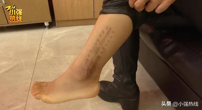 女子旅游崴脚骨折索赔18w,女子扭伤脚踝拆钢板赔偿