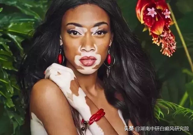 牛皮癣和白癜风有哪些区别,白癜风药膏可以治牛皮癣吗