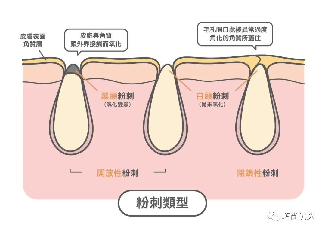 闭口粉刺终结篇,闭口粉刺护理全攻略