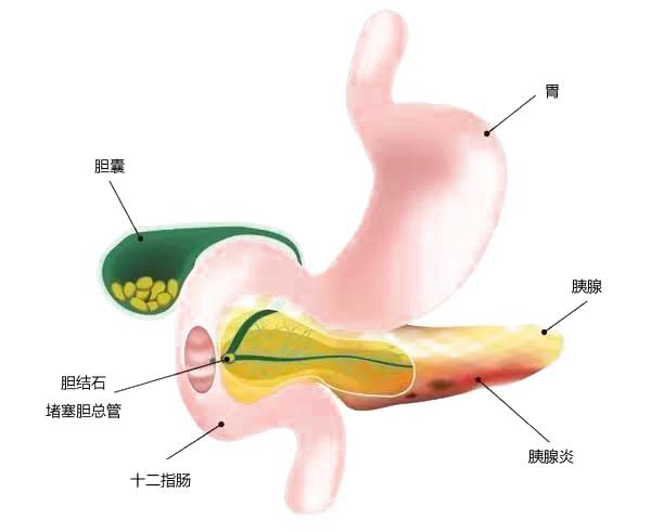 怎么才会导致胰腺炎,得了胰腺炎怎么能发展到胰腺癌