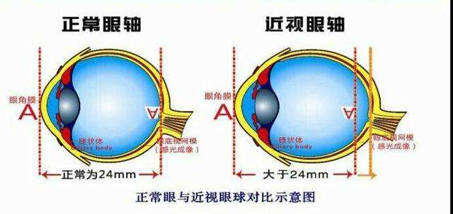 少年近视眼怎么恢复,近视眼怎么自然恢复儿童